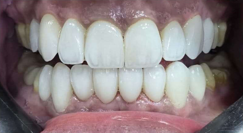 بعد — حشوات تجميلية أمامية في القصاصين